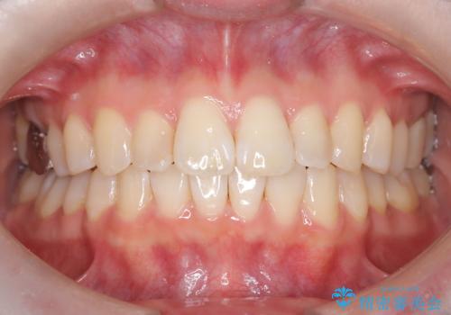 前歯のガタつきをマウスピース矯正で改善の症例 治療後
