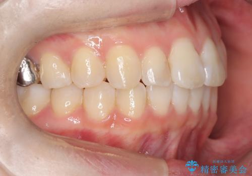 前歯のガタつきをマウスピース矯正で改善の治療後