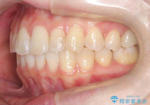 前歯のガタつきをマウスピース矯正で改善の治療後