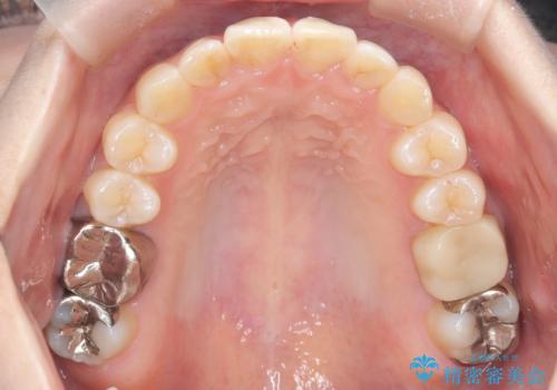 前歯のガタつきをマウスピース矯正で改善の治療後