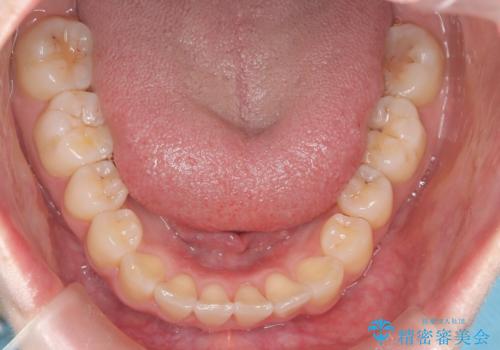 前歯のガタつきをマウスピース矯正で改善の治療後