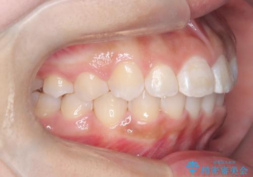 マウスピース矯正で前歯のガタツキを改善! ワイヤー矯正併用でかみ合わせもしっかり治しますの治療後