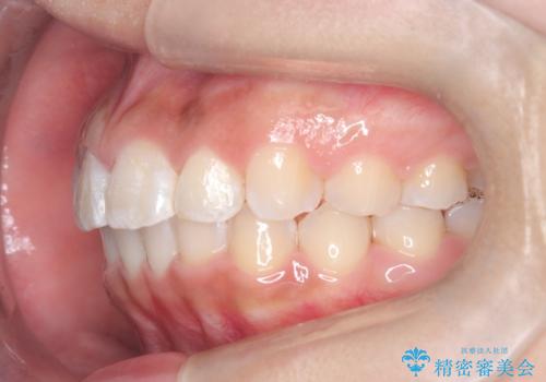 マウスピース矯正で前歯のガタツキを改善! ワイヤー矯正併用でかみ合わせもしっかり治しますの治療後
