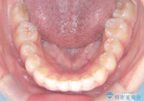 マウスピース矯正で前歯のガタツキを改善! ワイヤー矯正併用でかみ合わせもしっかり治しますの治療後