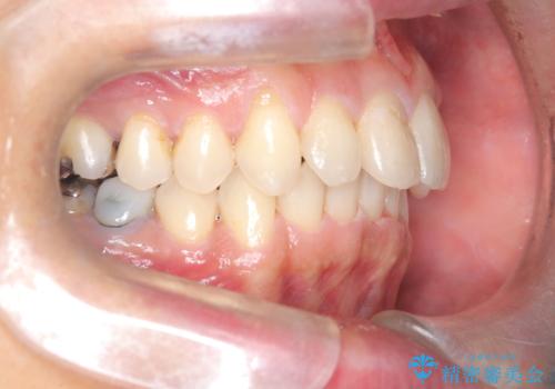 【遠心移動ワイヤー矯正】翼状捻転を治したいの治療後