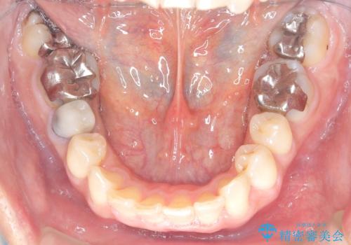 【遠心移動ワイヤー矯正】翼状捻転を治したいの治療後