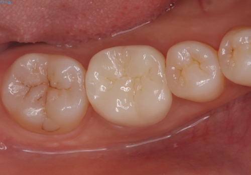 【根管治療】ラバーダムと顕微鏡を用いた治療の治療後