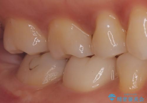 【根管治療】ラバーダムと顕微鏡を用いた治療の治療後