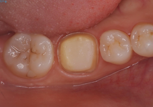 【根管治療】ラバーダムと顕微鏡を用いた治療の治療中