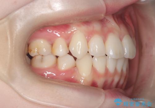 【抜歯ワイヤー矯正】前歯を引っ込めたいの治療後