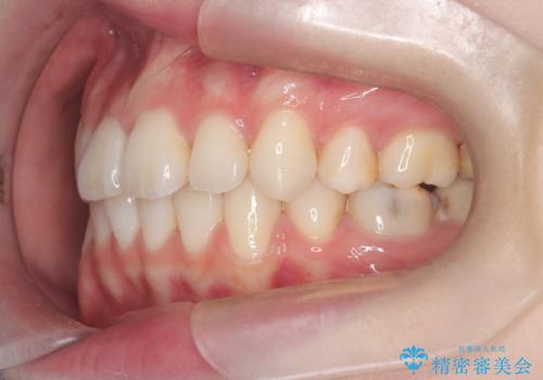 【抜歯ワイヤー矯正】前歯を引っ込めたいの治療後