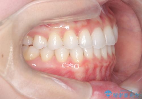 【インビザライン】前歯の凸凹をマウスピース矯正でなおしたいの治療後