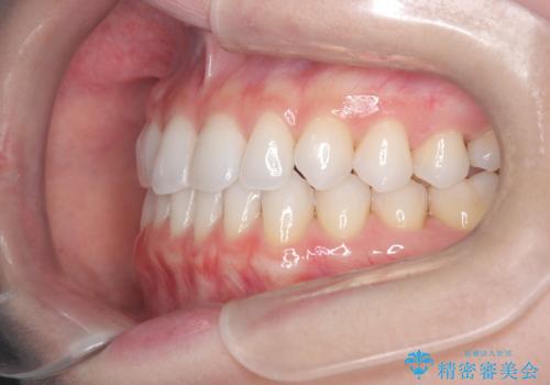 【インビザライン】前歯の凸凹をマウスピース矯正でなおしたいの治療後