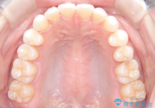 【インビザライン】前歯の凸凹をマウスピース矯正でなおしたいの治療後
