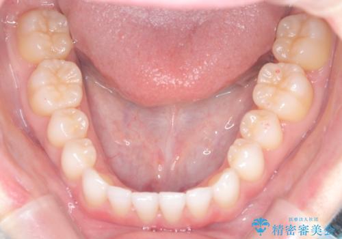 【インビザライン】前歯の凸凹をマウスピース矯正でなおしたいの治療後