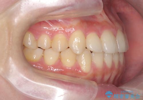 【ワイヤー矯正】インビザラインは途中でやめましたの治療後