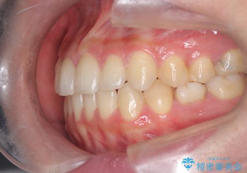 【ワイヤー矯正】インビザラインは途中でやめましたの治療後