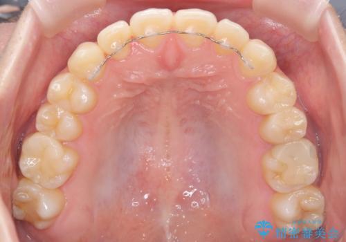 【ワイヤー矯正】インビザラインは途中でやめましたの治療後