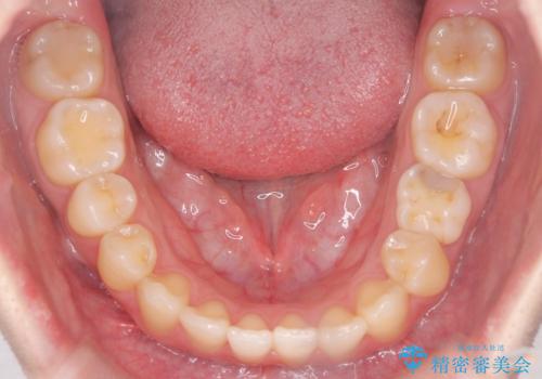 【ワイヤー矯正】インビザラインは途中でやめましたの治療後
