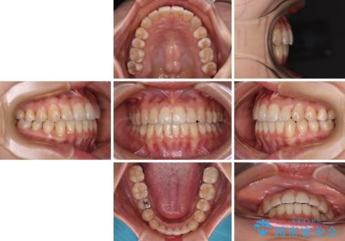 クロスバイトの前歯を改善 ワイヤー装置で楽々矯正治療の治療後