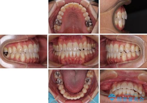 40代男性 今からでも遅くない インビザラインで綺麗な歯列を獲得の治療後