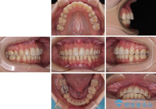 出っ歯を治したい ワイヤー装置での抜歯矯正で劇的変化!の治療後