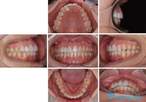 前歯のデコボコが気になる インビザラインによる矯正治療の治療後