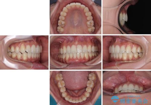 前に飛び出した上顎前歯をスッキリと引っ込める ワイヤー装置での矯正治療の治療後