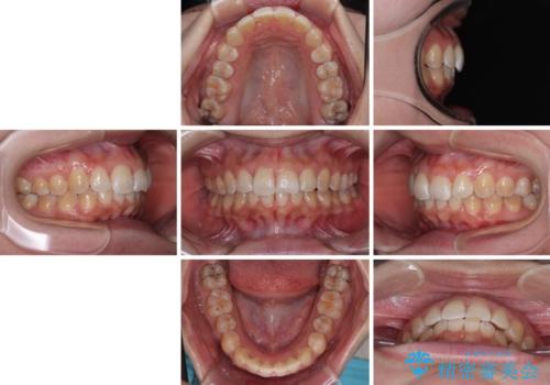 前歯のデコボコをインビザライン矯正で綺麗に改善の治療後