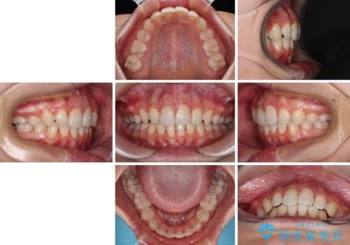 指が入るくらいに隙間のある上下前歯 抜歯矯正で横顔の印象が大きく改善の治療後