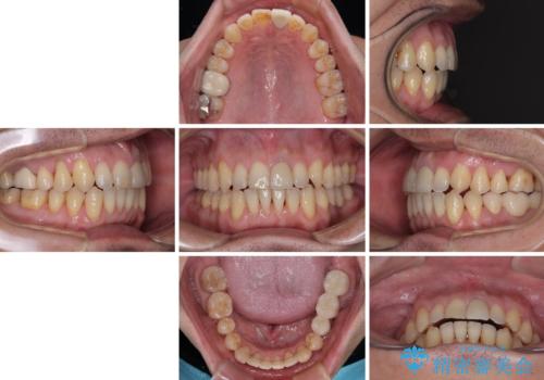 外科手術を検討? 過大な開咬をワイヤー装置とインビザラインで劇的に改善するの治療後