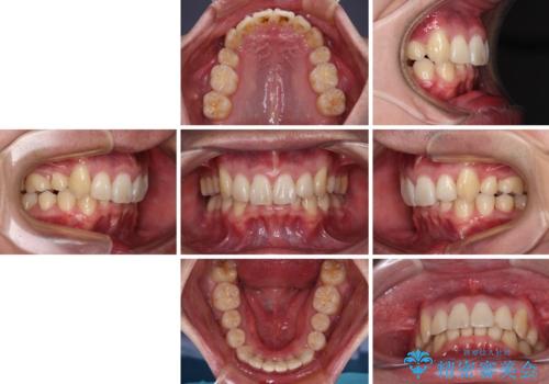 八重歯の抜歯矯正　インビザラインを用いて気になる歯並びを改善の治療後