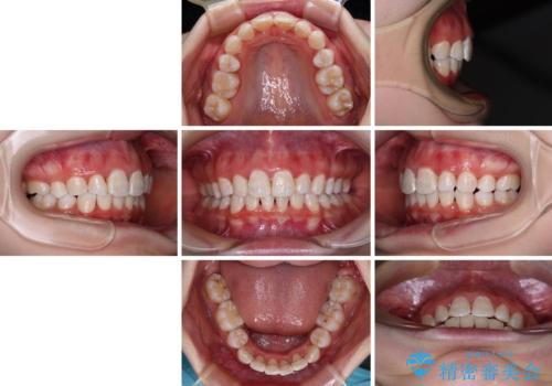 叢生・ディープバイト・突出 ワイヤー装置での抜歯矯正で全てを解決の治療後