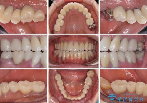 治療を開始したもののうまく噛めない 咬合改善のオールセラミック補綴治療の治療後