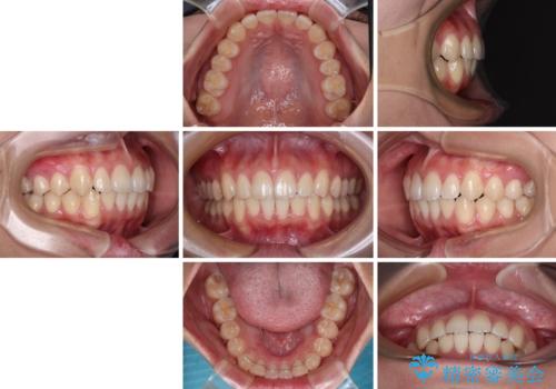 デコボコをワイヤー装置で改善 短期間で綺麗な仕上がりにの治療後
