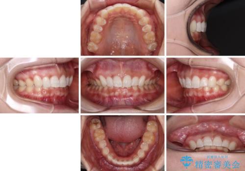 前歯のデコボコを治したい インビザライン矯正治療の治療後