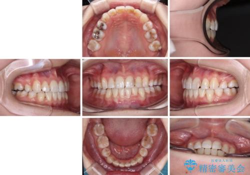 八重歯と正中のズレ　ワイヤー装置での抜歯矯正の治療後