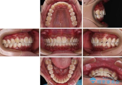 上顎前突とディープバイト ワイヤー矯正での確実に仕上げるの治療後