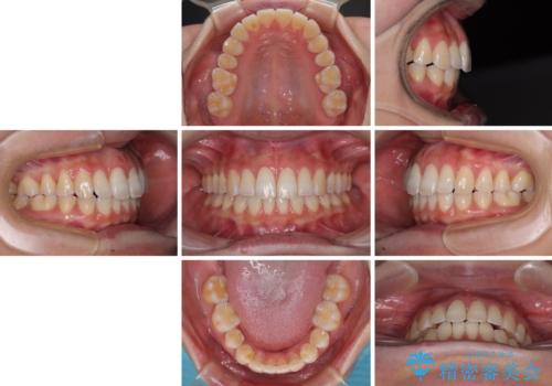 下顎前歯の欠損歯列 ワイヤー装置での矯正治療の治療後