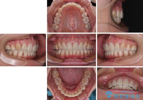上顎前突で口が閉じにくい ワイヤー装置での抜歯矯正の治療後