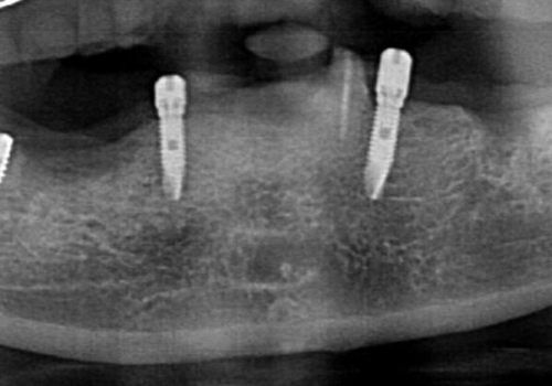 しっかり咬める入れ歯 インプラントオーバーデンチャーの治療後