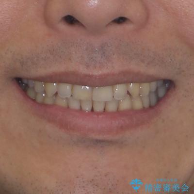 外科手術を検討? 過大な開咬をワイヤー装置とインビザラインで劇的に改善するの治療後(顔貌)