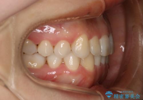 インビザライン矯正　短期間でがたつきのないきれいな歯並びにの治療後