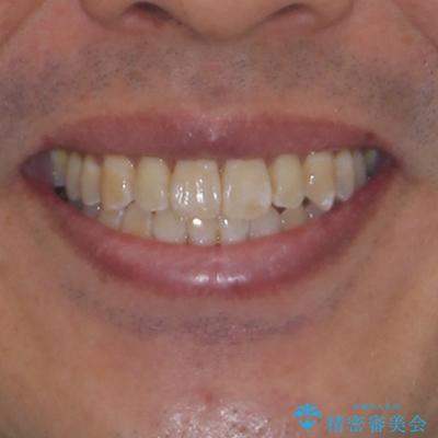 40代男性 今からでも遅くない インビザラインで綺麗な歯列を獲得の治療後(顔貌)