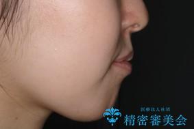 本来は外科ケース:インビザラインで前歯の重度がたつきとオープンバイトの改善の治療前(顔貌)