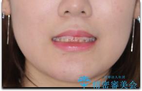 出っ歯と深い噛み合わせ:抜歯矯正で口元スッキリ!の治療前(顔貌)