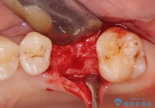 失った咬合機能の回復 インプラント治療の治療中