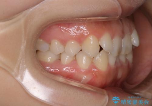 インビザライン矯正 短期間でがたつきのないきれいな歯並びにの治療前