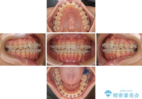クロスバイトの前歯を改善 ワイヤー装置で楽々矯正治療の治療中