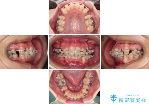 出っ歯を治したい ワイヤー装置での抜歯矯正で劇的変化!の治療中
